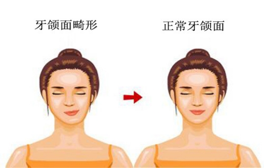 颅面不对称是什么原因引起的