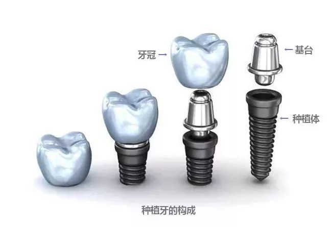 种植体的结构是什么 种植体有哪些分类