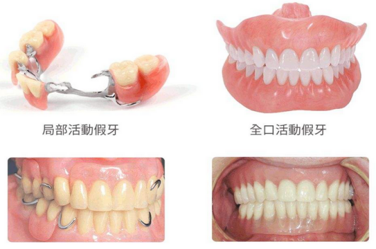 镶活动假牙好还是固定假牙好