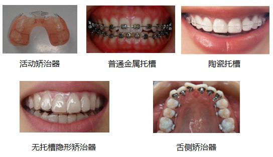 自锁托槽矫治、无托槽隐形矫治与舌侧矫治分别是什么样的