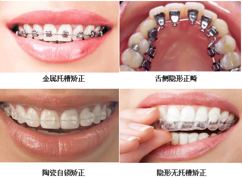 正畸矫治器有什么类型