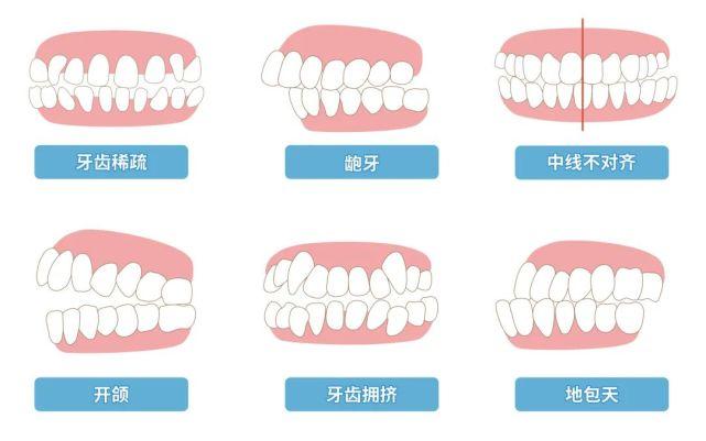 环境因素引起的错颌牙