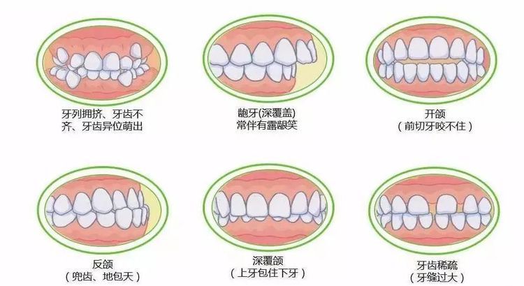 错颌畸形的先天因素是指什么
