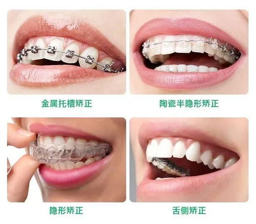 矫治器的类型怎么分类