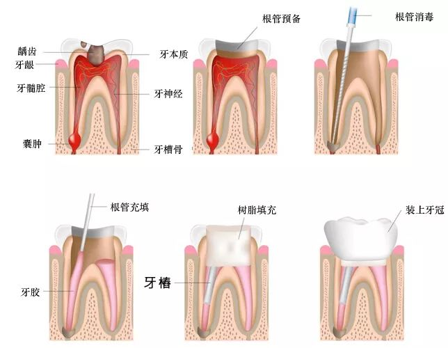 根管治疗的适应证和非适应证
