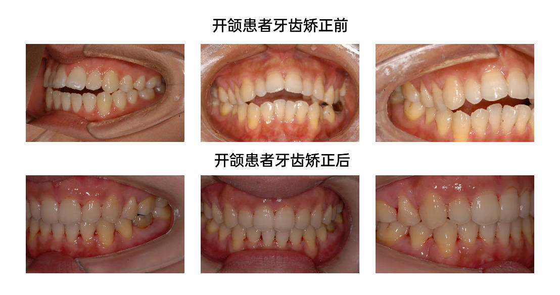开颌是怎么得的 开颌怎么治疗