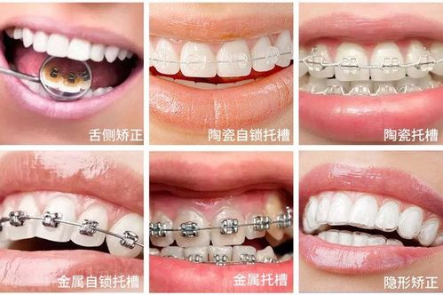 矫治器的工作原理是什么