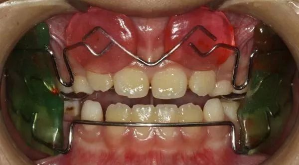 功能矫正器的作用方式是什么