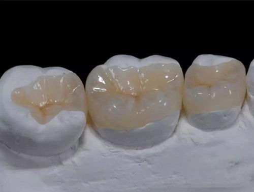 在树脂牙和烤瓷牙的选择中，可以考虑哪些额外的因素？
