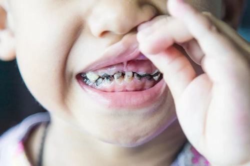 小朋友龋齿需要治疗吗？孩子可以做根管治疗吗？
