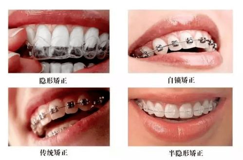 自锁托槽和非自锁托槽有什么区别？怎么选择合适的牙齿矫正器？